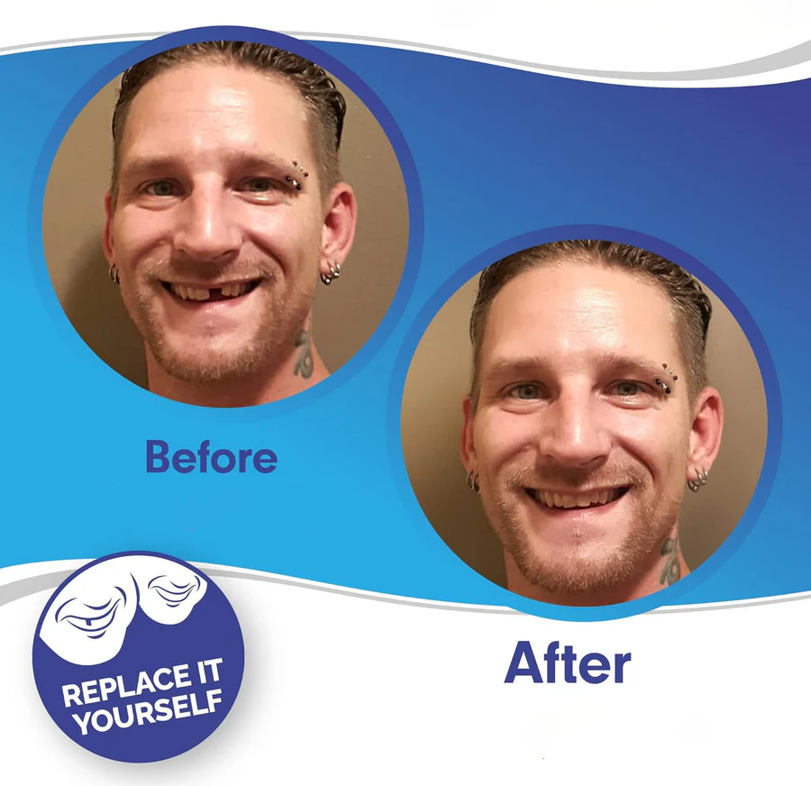 Dental Veneer Kit with Upper and Lower Covers