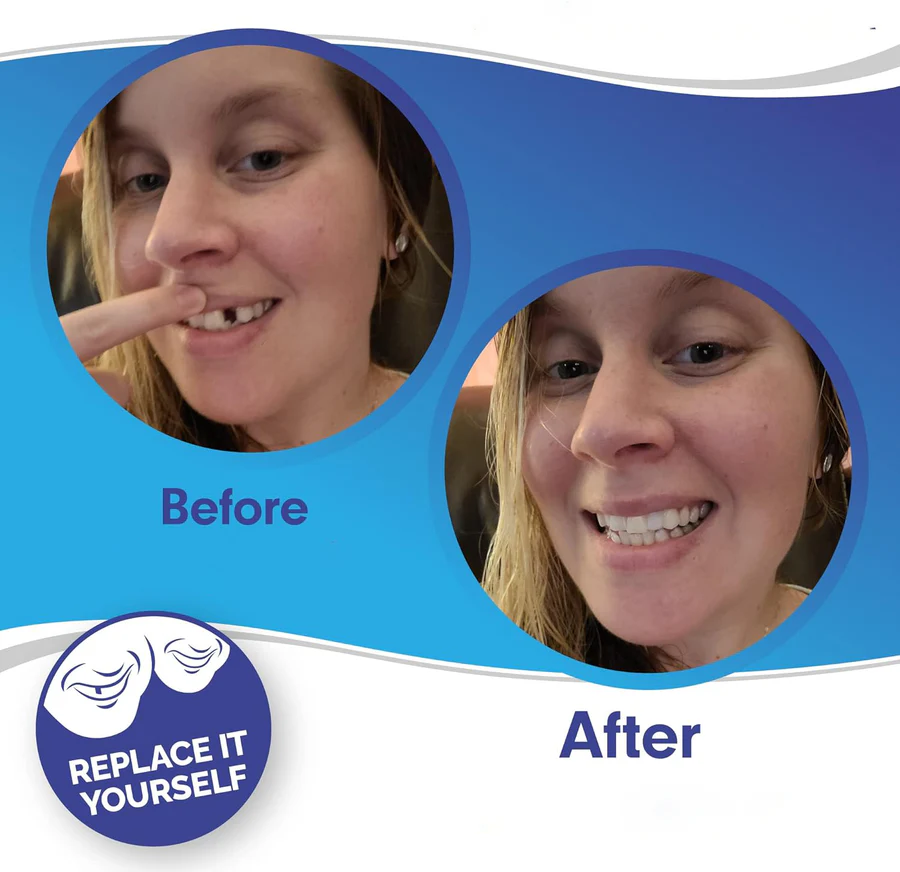 Dental Veneer Kit with Upper and Lower Covers