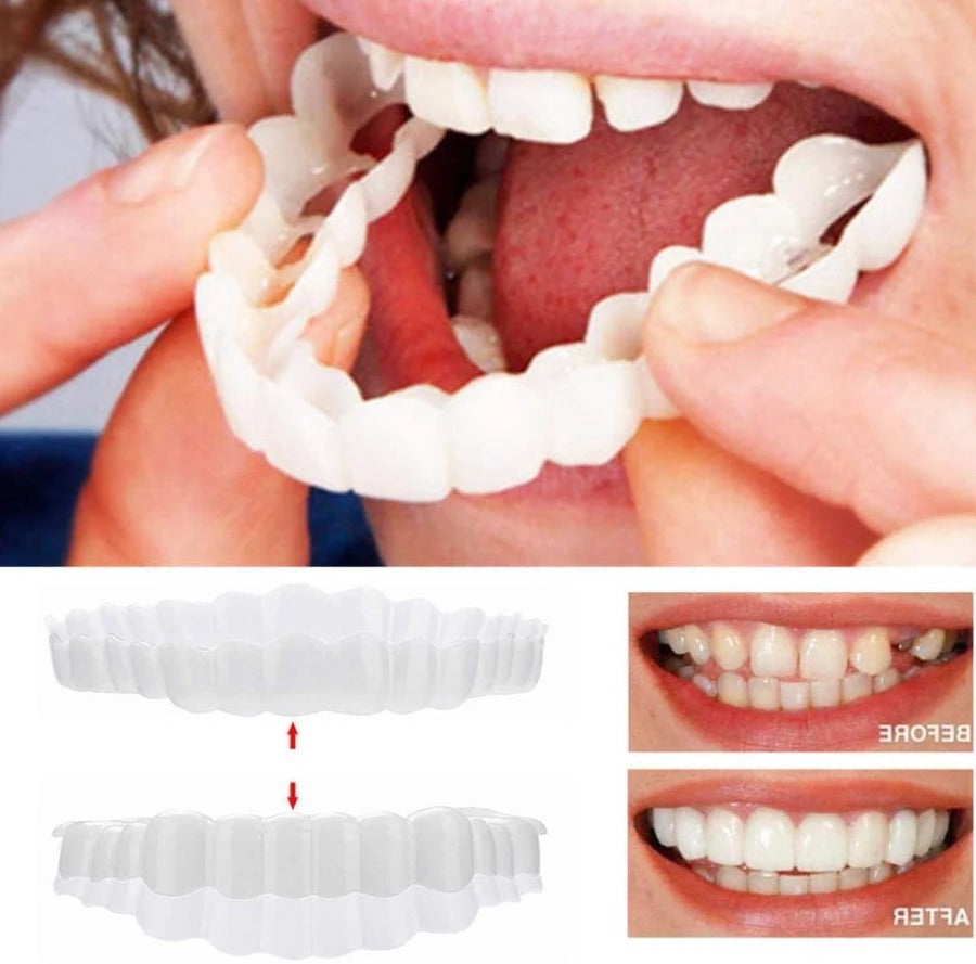 Dental Veneer Kit with Upper and Lower Covers