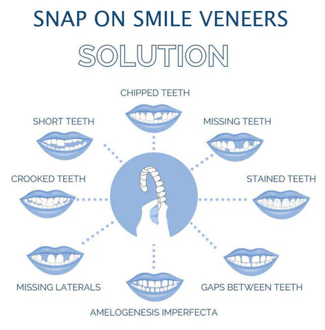 Dental Veneer Kit with Upper and Lower Covers