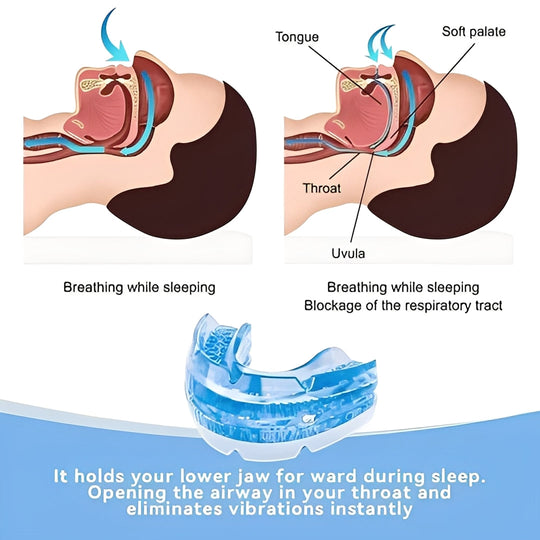 Mouthguard with Adjustable Fit and Custom Moldable Design