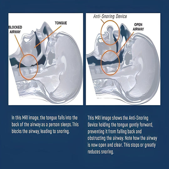 Sleep Aid with Tongue Positioning and Airflow Support